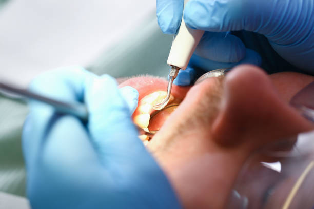 Best Emergency Treatment for Dental Infections or Abscesses in Glen Burnie, MD